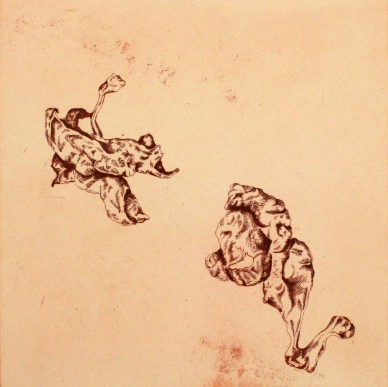 Chocolate Cysts of The Ovary I