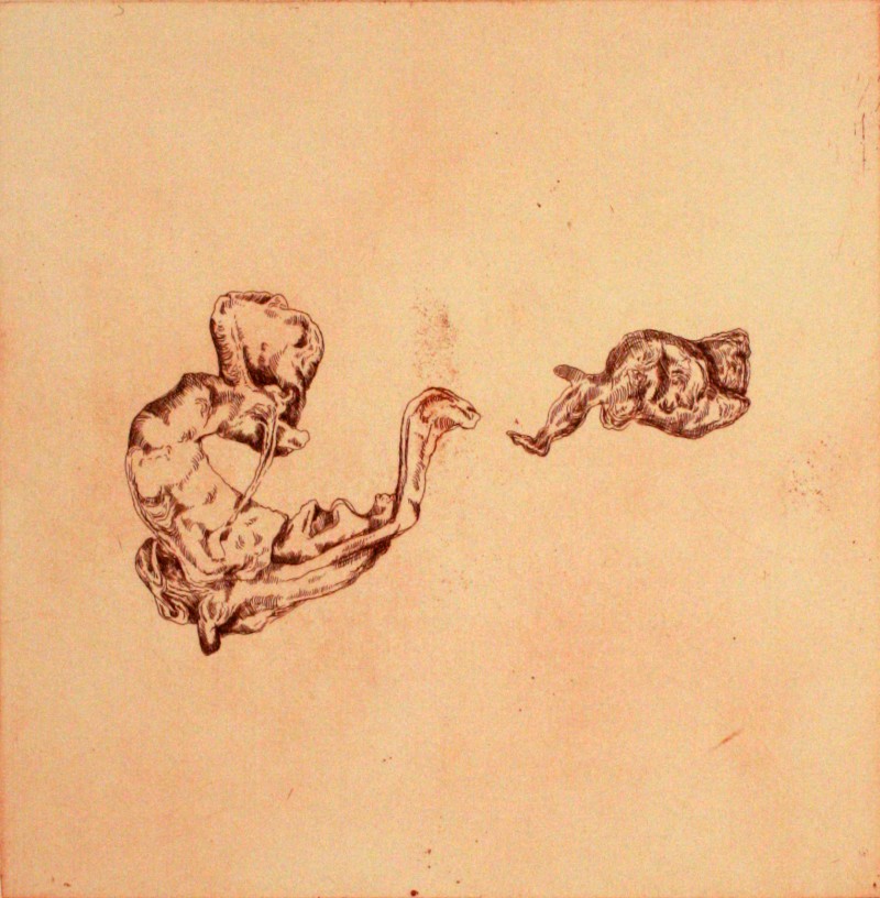 Chocolate Cysts of The Ovary II