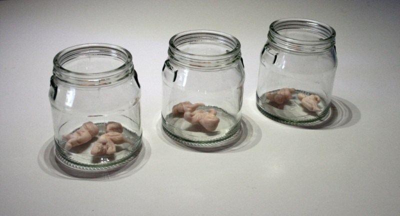 Chocolate Cysts of The Ovary